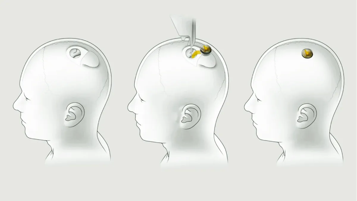 Neuralink Implants First Brain-Reading Device into a Human